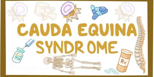 cauda equina syndrome with sciatica ιππουριδική συνδρομη