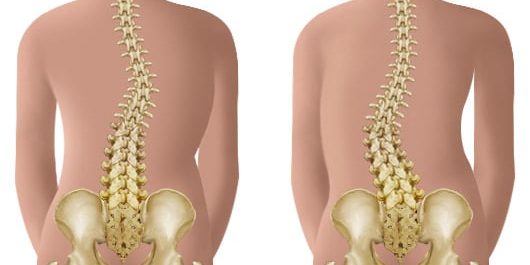 types-of-scoliosis